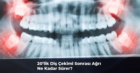 20’lik Diş Ameliyatı Ne Kadar Sürer?
